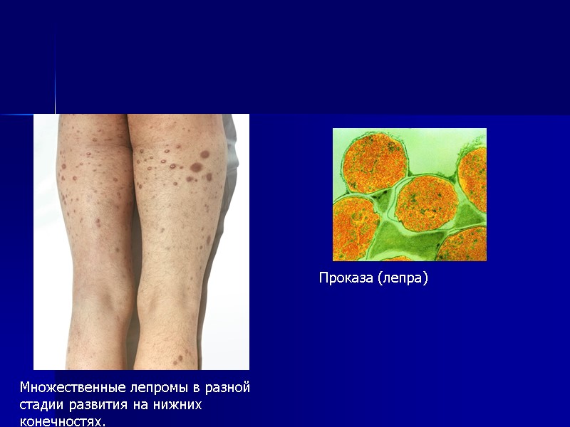 Множественные лепромы в разной стадии развития на нижних конечностях. Проказа (лепра)
